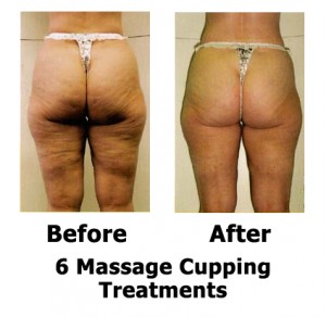 6 treatments out for cellulite