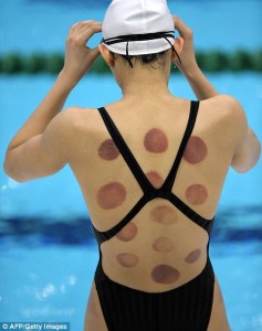 Chinese swimmer cupping marks